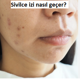 Sivilce İzi Nasıl Geçer?