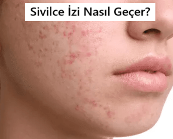 Sivilce İzi Nasıl Geçer?