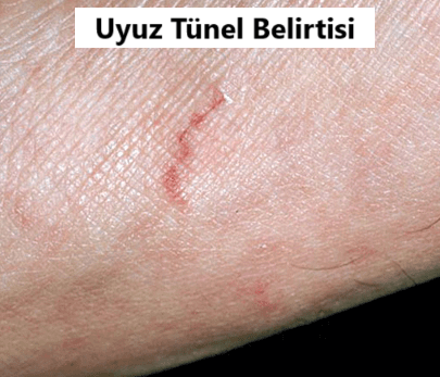 uyuz tunel belirtisi