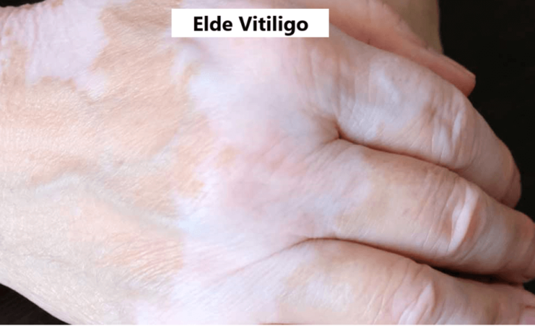 vitiligo görseli