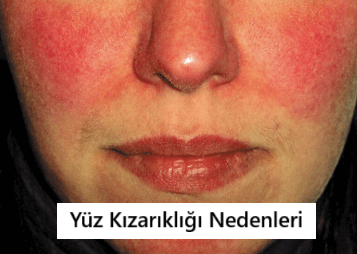 Yüz Kızarıklığı Neden Olur? Yüz Kızarıklığı Nasıl Geçer? (Resimli)