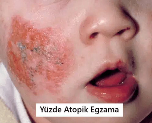 yüzde atopik egzama