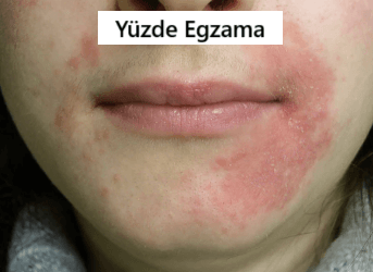 yüzde egzama