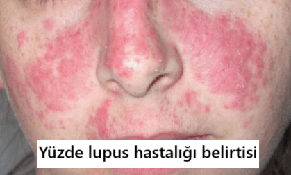 yüzde lupus hastalığı