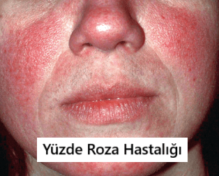 yüzde roza hastalığı