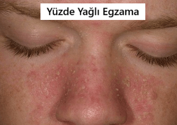 yüzde yağlı egzama