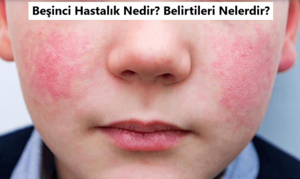 beşinci hastalık nedir