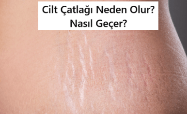 Çatlak Tedavisi