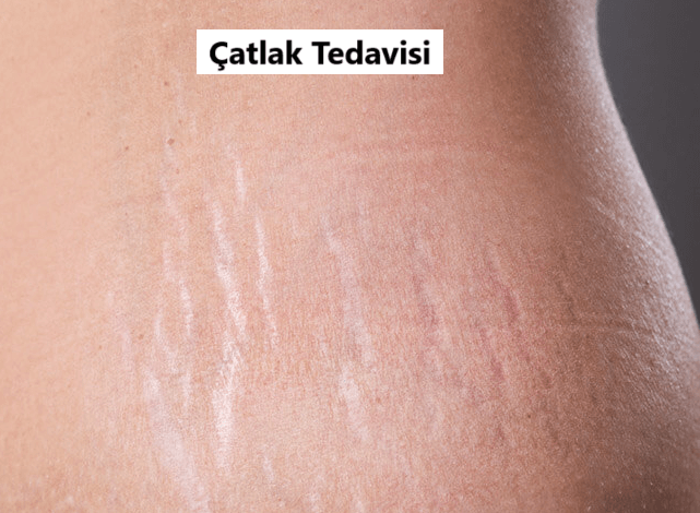 deri çatlağı tedavisi