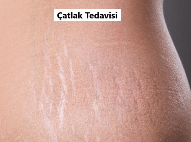 Çatlak Tedavisi