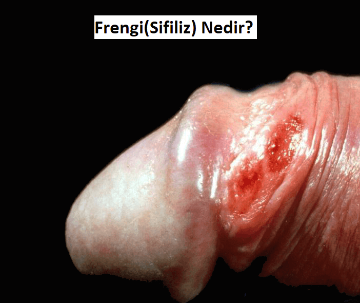 Frengi Nedir? Belirtileri, Evreleri, Nasıl Bulaşır?