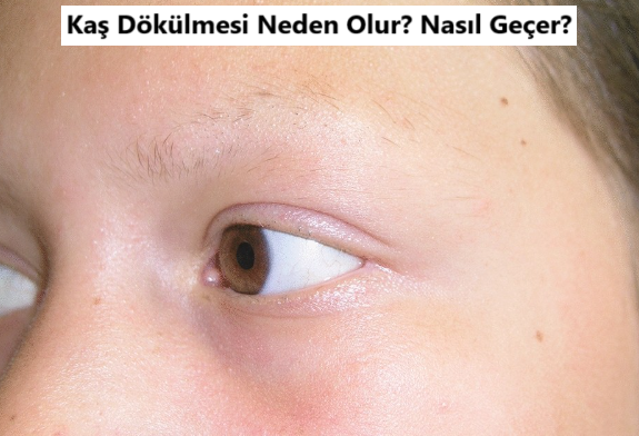 Kaş Dökülmesi Neden Olur?