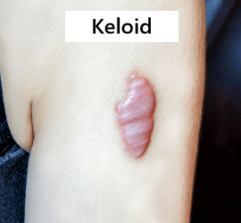 keloid nedir