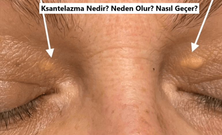 ksantelazma nedir