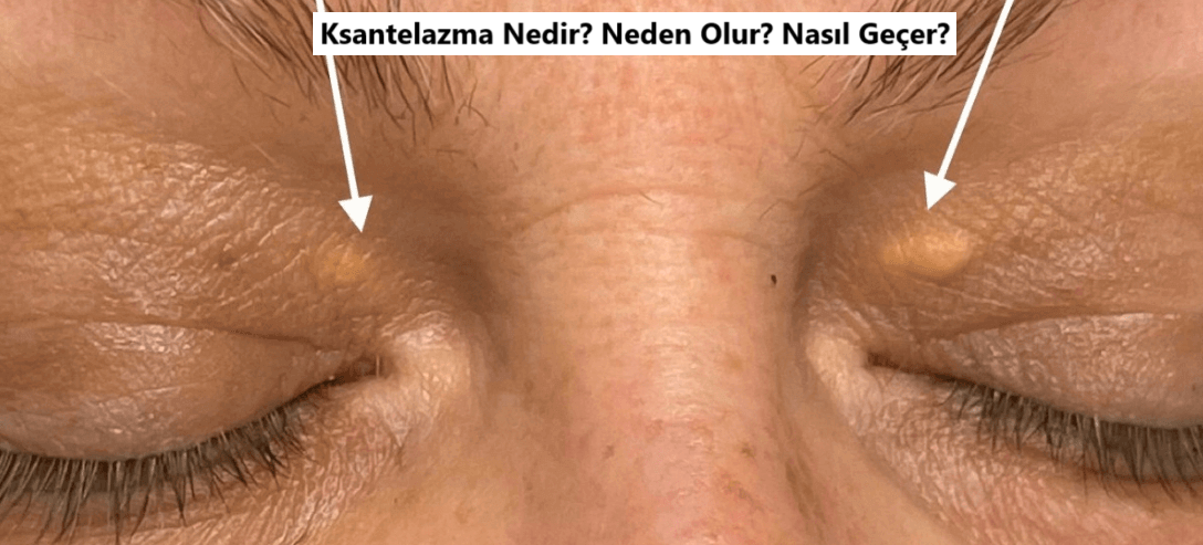 Ksantelazma Nedir? Ksantelazma Tedavisi