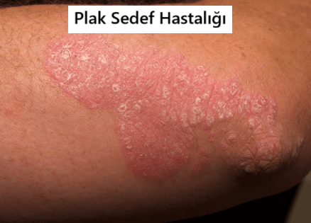 plak sedef hastalığı