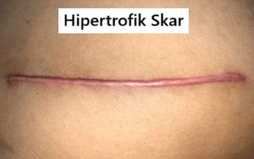 yara izi fotoğrafı