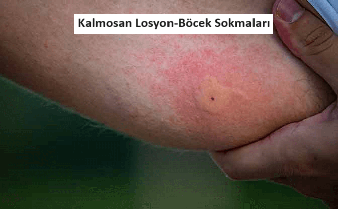 kalmosan losyon ne için kullanılır