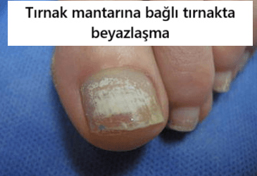tırnakta beyazlaşma nedenleri