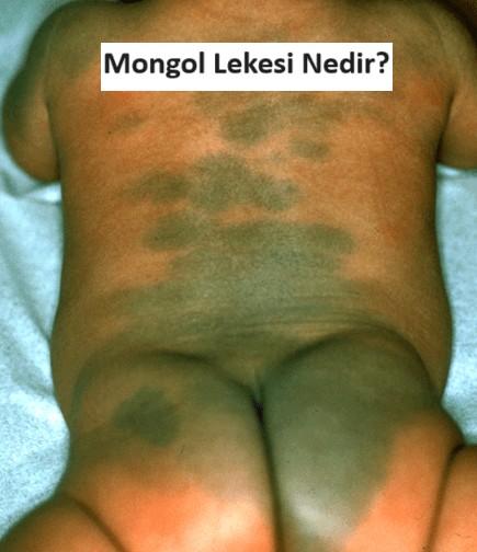 Mongol Lekesi Nedir?