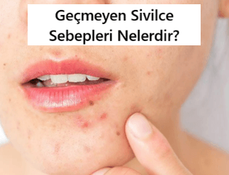 geçmeyen sivilce sebepleri