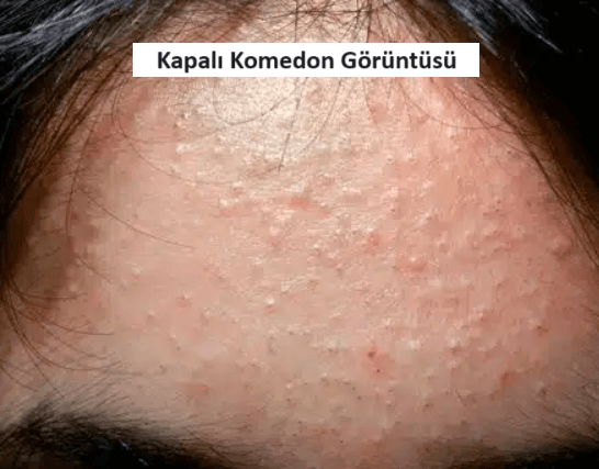 kapalı komedon resmi