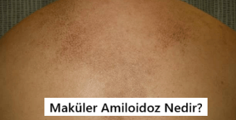 Maküler Amiloidoz Nedir?