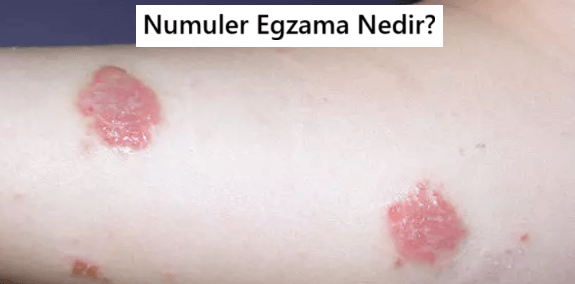 Numuler Egzama Nedir?