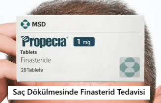 Finasterid: Erkek Tipi Saç Dökülmesi Tedavisi