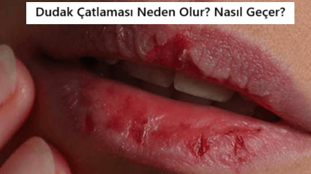 dudak çatlaması neden olur