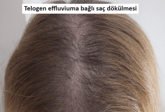 telogen effluviuma bağlı saç dökülmesi
