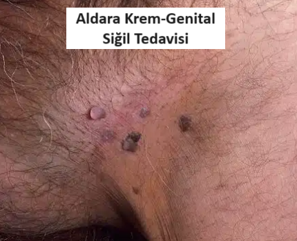 aldara siğil kremi