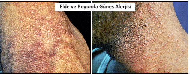 elde ve boyunda güneş alerjisi görüntüsü