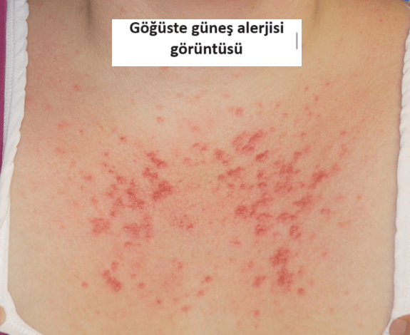 göğüste güneş alerjisi döküntüsü