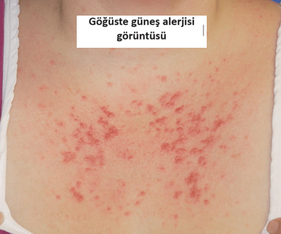 Güneş Alerjisi Nedir? Güneş Alerjisi Belirtileri Nelerdir?