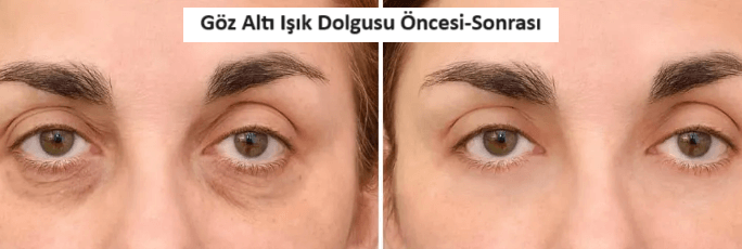 göz altı ışık dolgusu öncesi sonrası