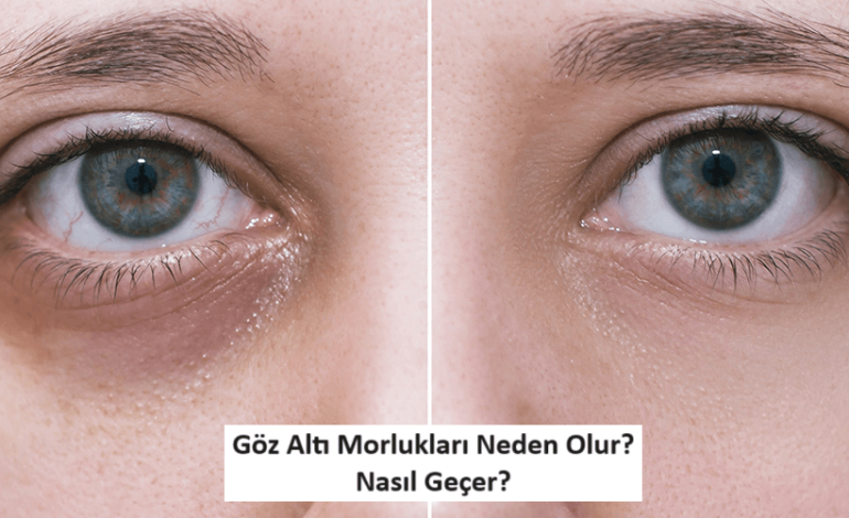 Göz Altı Morlukları Neden Olur? Nasıl Geçer?