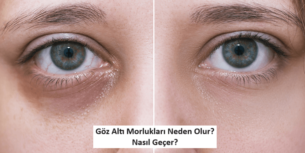 Göz Altı Morlukları Neden Olur? Nasıl Geçer?