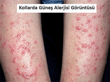 güneş alerjisi görselleri