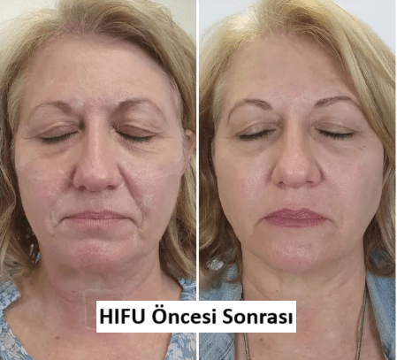 HİFU Nedir? (Ameliyatsız Yüz ve Cilt Gençleştirme Tedavisi)