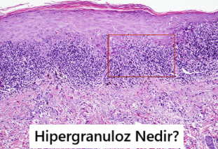 hipergranüloz nedir