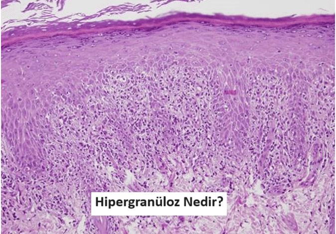 hipergranüloz nedir