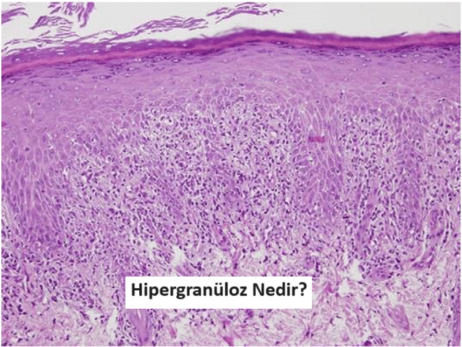 Hipergranüloz Nedir?