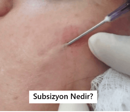 Subsizyon Nedir?