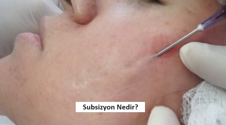 subsizyon nedir