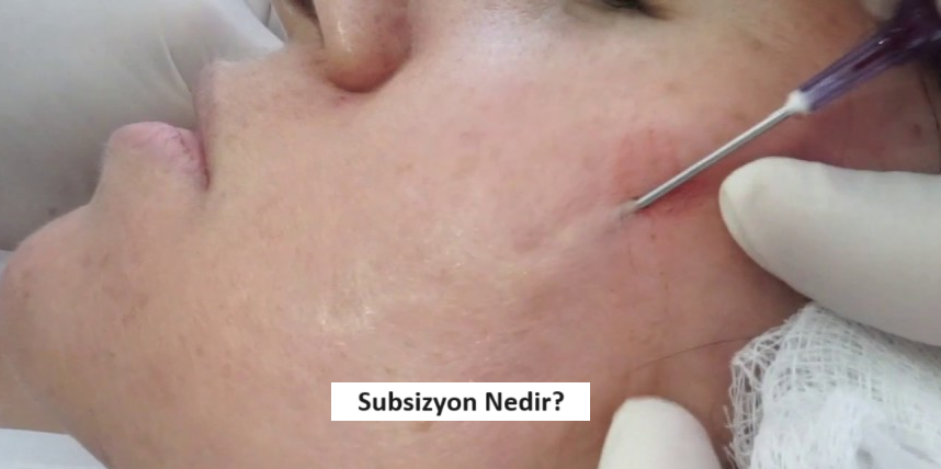 subsizyon nedir