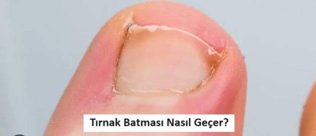 Tırnak Batması Neden Olur? Tırnak Batması Nasıl Geçer?