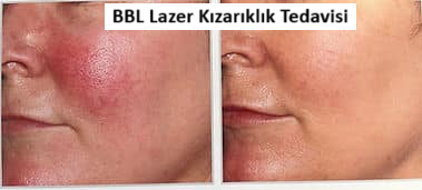 bbl lazer nedir