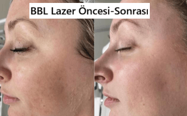 BBL Lazer: Kullanımı ve Etkileri
