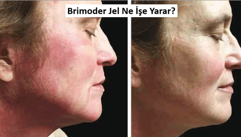 brimoder jel öncesi sonrası